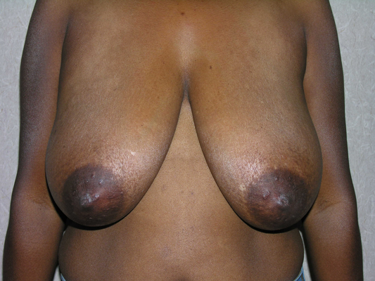 breast reduction surgery before and after. Surgery Before and After