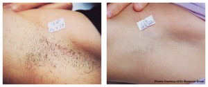 Laser Hair Removal  Fort Lauderdale FL ZROC Dermatology