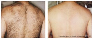 Guide to Laser Hair Removal  Forefront Dermatology