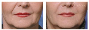 res-07-099a-restylane-ba1